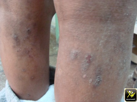 Dermatite atopique grand enf Pigmentation post grattage et inflammation 300412 (1) [1600x1200]