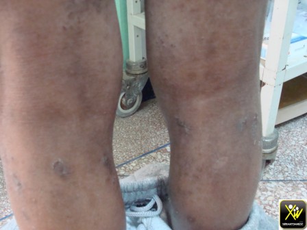 Dermatite atopique grand enf Pigmentation post grattage et inflammation 300412 [1600x1200]
