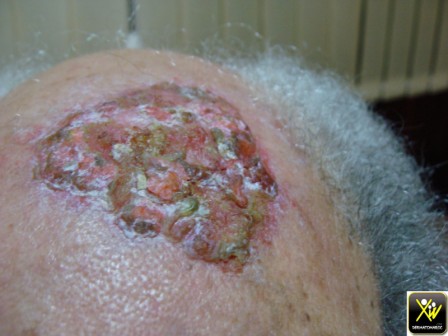 erosive pustular dermatosis of the scalp 300414 (2)  [1600x1200]