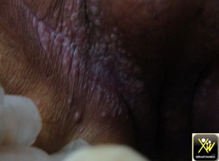 Chimio Douleur Cuir Chevelu