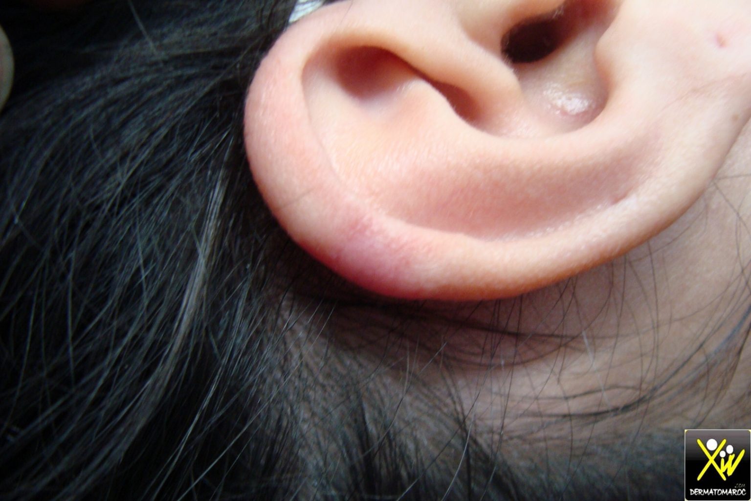 Un Dermato Peut Il Reboucher Un Piercing