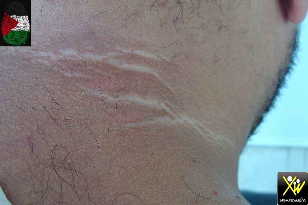 3_acanthosis-nigricans-benin-obesite-12092026-Copier-Copier-Copier