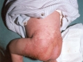 Acrodermatite enteropathica congenita