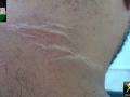 3_acanthosis-nigricans-benin-obesite-12092026-Copier-Copier-Copier