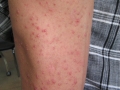 acne cortisonique monomorphe