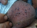 Angiokeratomes scrotaux