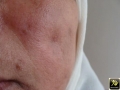 Atrophie cutanée popst lupus discoide.