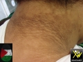 Acanthosis-nigricans-300412-1