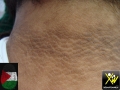 Acanthosis-nigricans-300412-2