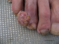 Botriomycome, Bourgeon charnu.