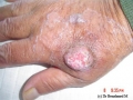 Carcinome epidermoide.