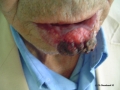 Carcinome epidermoide.