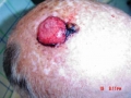 Carcinome epidermoide.