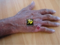 Carcinome epidermoide.