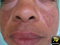 Chloasma.