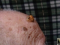 Carcinome epidermoide.