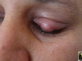 Chalazion.