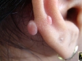 Cheloide post piercing.