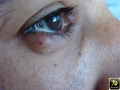 Chalazion.
