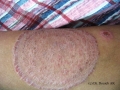dermatophytie