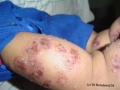 dermatite herpetiforme