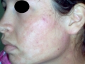 dermite de contact allergique