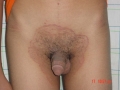 dermatophytie