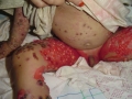 dermatose bulleuse