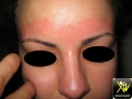 dermatite de contact allergique à la cire