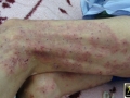 dermatite herpetiforme