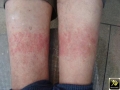 dermatite de contact allergique