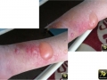 dermatite de contact allergique