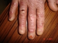 Epidermolyse bulleuse hereditaire.