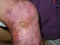 Epidermolyse bulleuse hereditaire.