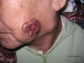 Epithelioma spino cellulaire.