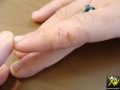 Eczema fissuraire.