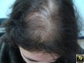 Effluvium telogene.