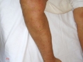 Herpes circiné eczematisé.