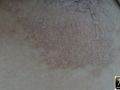 Erythrasma.