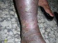 Eczema sur elephantiasis.