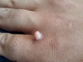 fibrokeratome-250619