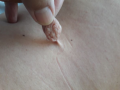 Fibrome mou " molluscum pendulum"