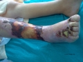 Gangrene.