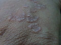 granulome-annulaire-200217-2-min