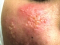 Herpes.
