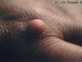 Histiocytofibrome.