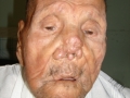 Hensen, maladie de.