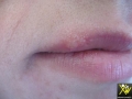 Herpes.