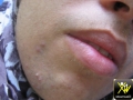 Hirsutisme.