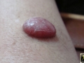 Histiocytofibrome.